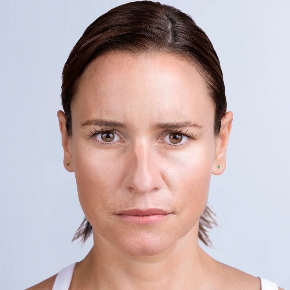dermal-fillers-13-After-Broklyn-NY-Park-Slope-Laser