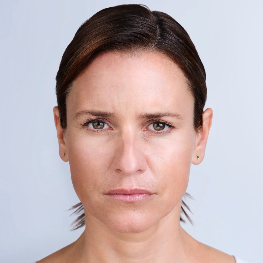 dermal-fillers-14-After-Broklyn-NY-Park-Slope-Laser