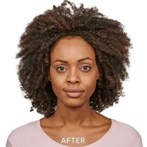 JEAVEAU-before-and-after-1b-park-slope-laser-brookly-NY