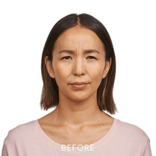 JEAVEAU-before-and-after-2a-park-slope-laser-brookly-NY