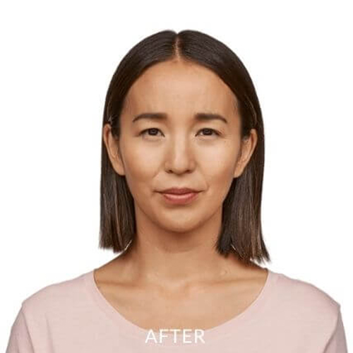 JEAVEAU-before-and-after-2b-park-slope-laser-brookly-NY