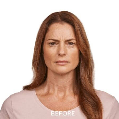 JEAVEAU-before-and-after-3a-park-slope-laser-brookly-NY
