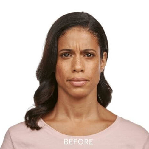 JEAVEAU-before-and-after-4a-park-slope-laser-brookly-NY