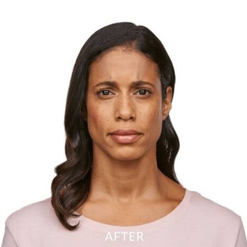 JEAVEAU-before-and-after-4b-park-slope-laser-brookly-NY