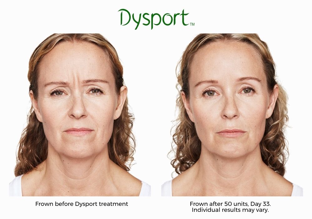 dysport-before-and-after-Brookly-NY-Park-slope-laser-02