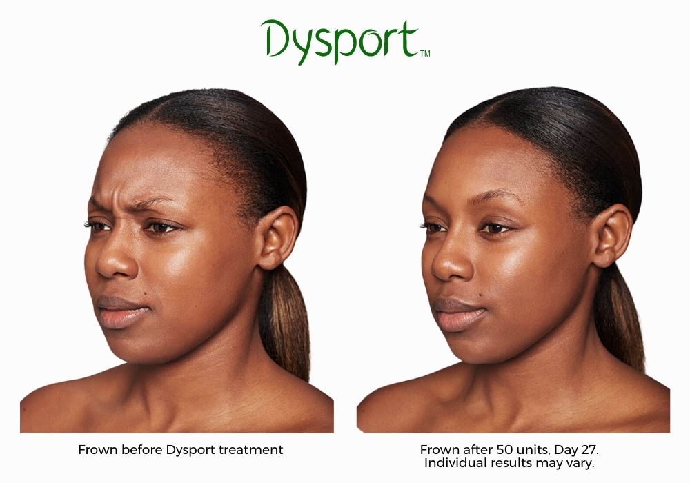 dysport-before-and-after-Brookly-NY-Park-slope-laser-03