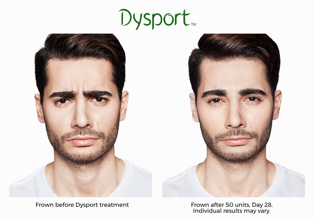 dysport-before-and-after-Brookly-NY-Park-slope-laser-04