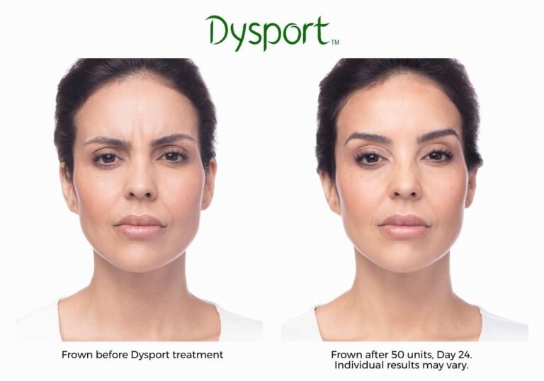 dysport-before-and-after-Brookly-NY-Park-slope-laser-01